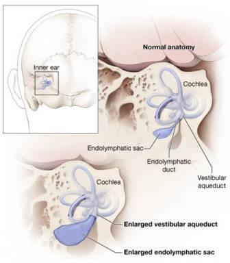 vestibular disease enlarged vestibular aqueduct evas vestibular disorders association vestibular disease enlarged vestibular aqueduct evas vestibular disorders association