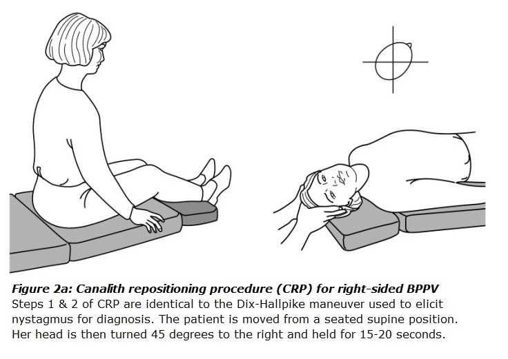 Figure 2a: Steps 1 & 2 of CRP are identical to the Dix-Hallpike maneuver used to elicit nystagmus for diagnosis. The patient is moved from a seated supine position. Her head is then turned 45 degrees to the right and held for 15 to 20 seconds.