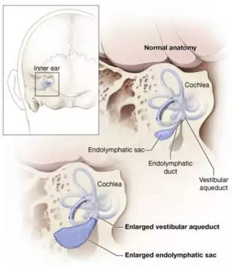 Enlarged Vestibular Aqueduct Syndrome