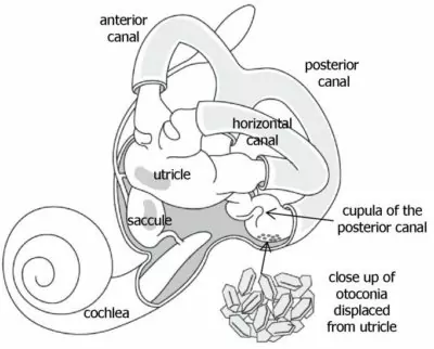BPPV - diagram of inner ear showing where crystals or otoconia are located.