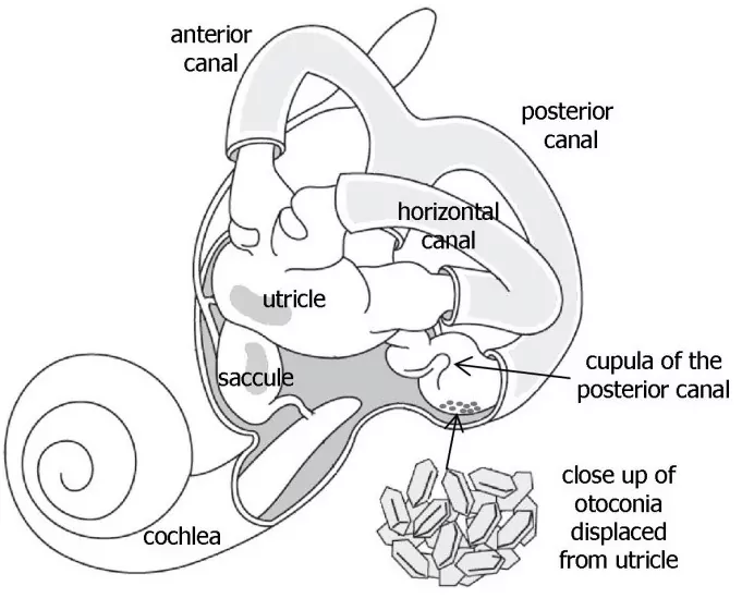 Benign Paroxysmal Positional Vertigo (BPPV) - Vestibular Disorders Association