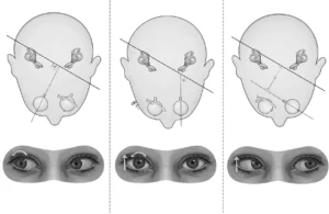 Graphic showing BPPV nystagmus depends on eye position.