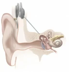 Cochlear implant graphic